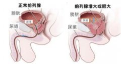 患了前列腺肥大该如何护